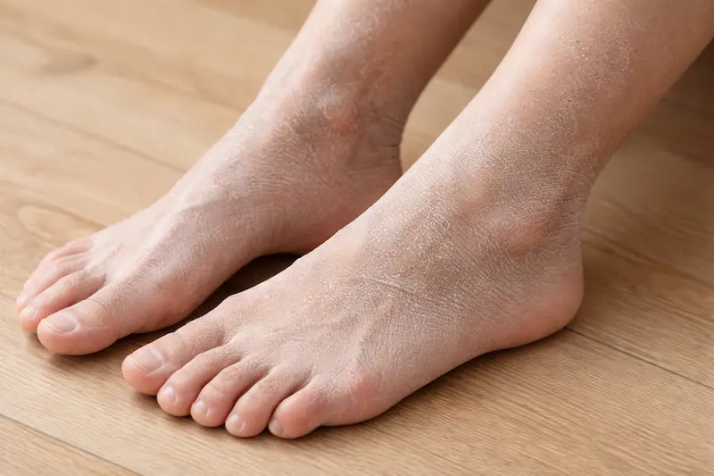 カサカサで白くなった足